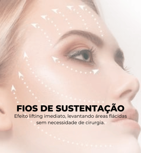 FIOS DE SUSTENTAÇÃO Efeito lifting imediato, levantando áreas flácidas sem necessidade de cirurgia